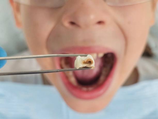 Best Emergency Dental Care for Broken or Chipped Teeth in Fairfax, OK